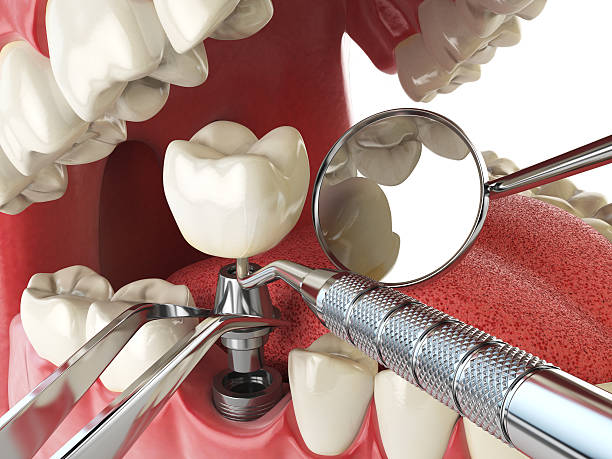 Best Emergency Tooth Extraction in West Point, NE